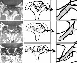 In association of with spinal disc, this ligament works essentially as a shock absorber. Measurements Of Ligamentum Flavum Thickening At Lumbar Spine Using Mri Springerlink