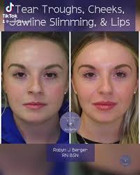 This gorgeous young beauty wanted some subtle “tweakments” to refine her  already gorgeous face. 😍💉🥰, ., Here is a side by side before and after  having treated her Tear troughs, cheeks, lips, and ...