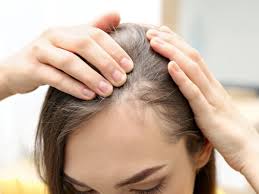 Hair Loss Treatment for Women
