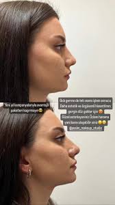 g5masajı #zayıflama#selülittenkurtulma #selülitgiderme #heykeltraş #l...