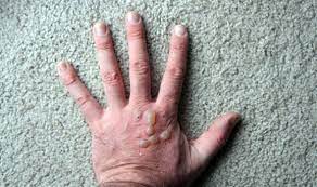 This can be due to friction during shaving. How To Get Rid Of A Blood Blister The 4 Things To Avoid Express Co Uk