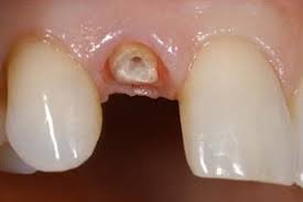 Beneficiile unui implant dentar reusit. Implant Dentar Intr O Zi