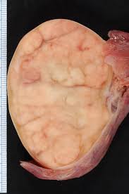 Testicular cancer is a relatively rare type of cancer that affects the testicles. Testicular Cancer Wikipedia