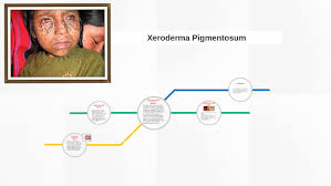 Precancerous lesions need to be. Xeroderma Pigmentosum By Michael Scallion On Prezi Next