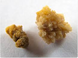 Kidney Stones In Children