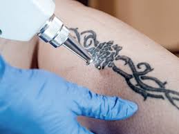Bfs Tattooentfernung Entfernung Von Tattoos