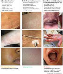 Approach To Beta Lactam Allergy In Critical Care Emcrit Project