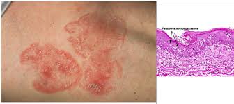 Definition / general angioimmunoblastic t cell lymphoma (aitl) is a peripheral t cell lymphoma characterized by systemic disease, a polymorphous infiltrate involving lymph nodes, and a prominent proliferation of high endothelial venules and follicular dendritic cells (who 2008) 16 Best Cutaneous T Cell Lymphoma Ideas T Cell Lymphoma Cell