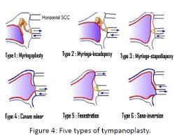 Image result for Ossicular Chain Disruption
