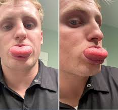 Man films his massively swollen tongue after he was stung by a bee while  eating a burger