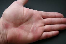 Though herpes simplex virus (hsv) infections can be transmitted through sex, that's not the only way the virus is passed between people, according to shingles, another viral rash, is a reactivation of the chicken pox virus, according to the cdc. Herpes On Hands Ehealthiq