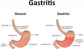 Gastritis Magenschleimhautentzundung Ursachen Symptome Behandlung