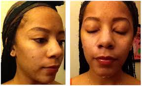 My First Chemical Peel Review with Pictures- Mocha Girls Pit Stop