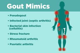 According to the crohn's & colitis foundation, arthritis is the most common complication of ibd that occurs the medical community refer to joint pain without swelling as arthralgia. Gout Misdiagnosis Diseases Gout Can Be Mistaken For