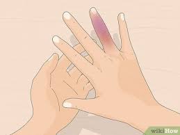 Feb 16, 2019 · 6wks: 4 Ways To Treat A Broken Finger Wikihow