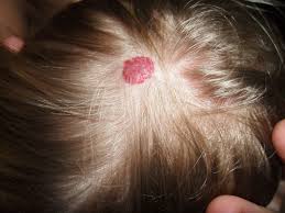 Medical involvement is really not helpful and not indicated in the treatment of these lesions. Hemangioma Wikipedia