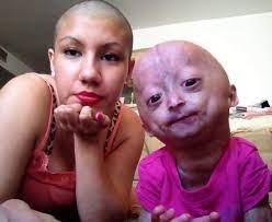 Adalia Rose The Six Year Old Girl With Body Of An Old Woman Due To Progeria Daily Mail Online