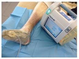 Check spelling or type a new query. Management Of Negative Pressure Wound Therapy In The Treatment Of Diabetic Foot Ulcers