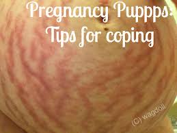 Drink two cups daily of the organic brand. Pregnancy Puppps Rash Essential Tips For Coping