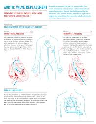 Infographic Aortic Valve Replacement Http Www Columnfivemedia Com Work Items Infographic Aort Aortic Valve Replacement Cardiac Nursing Bicuspid Aortic Valve