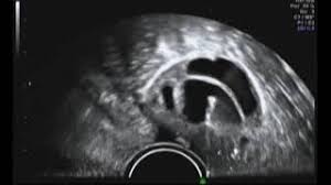 One full cycle of ivftakes about three weeks. Ivf Egg Retrieval In Vitro Egg Aspiration Process Video