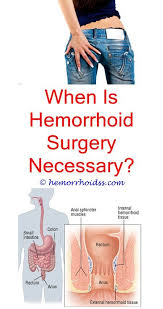 Pin On Hemorrhoids Symptoms