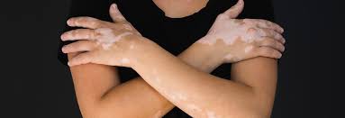 The vitiligo global issues consensus conference. We Can Treat Your Vitiligo Find Out What Procedures North Pacific