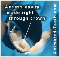 If you are receiving treatment in two appointments, the. Root Canal Treatment On Crowned Teeth Working Through The Crown Vs Removing It