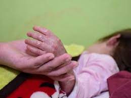Esperan Ayuda Para Nina Con Enfermedad Genetica Incurable El Diario Ecuador