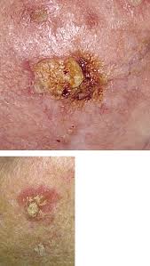 Learn about the academy's efforts to refocus its brand on education. Actinic Keratosis