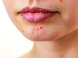 We got the lowdown from a urologist. Tired Of Breakouts Stop Eating These Three Food Items To Get Rid Of Acne The Times Of India