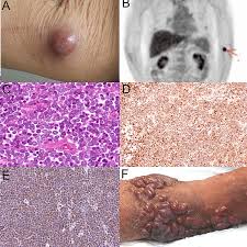 Image result for Merkel Cell Carcinoma