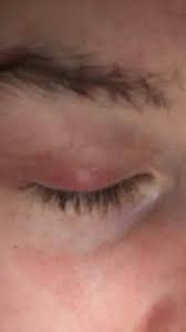 Geschwollenes Und Rotes Augenlied Was Hilft Gesundheit Und Medizin Augen Rot