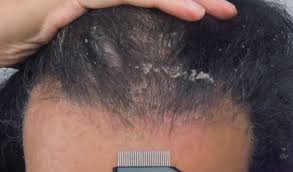 Seboreik egzama olarak da bilinen seboreik dermatit, kızarıklığa, pul pul parçalara ve kepeğe sebep olan oldukça yaygın bir deri rahatsızlığıdır. Seboreik Dermatit Egzama Hastaliginda Sac Ekimi Yapilir Mi Https Sacekiminetwork Com Seboreik Dermatit Egzama Hastaliginda Sac E Sac Sac Dokulmesi Genetik