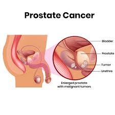 It can be tricky to identify prostate cancer in its early stages without a screening. Nutech Cancer Biomarkers India Pvt Ltd