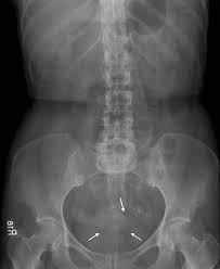 Analyzing the normal anatomy we found several variations and pathologies of the vhf, such as missing muscles (gemellus superior, psoas minor), additional veins as well as spondylophytes (vertebral column, pubic bone), and colon diverticula. Left Lower Quadrant Abdominal Pain Caused By An Iucd Gut