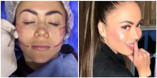 Comenzó su cuenta de instagram en septiembre del 2017. Epa Colombia Ademas De 5 Cirugias Se Perfilo El Rostro Canal 1