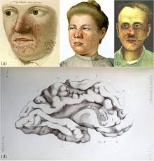Neurocutaneous syndromes in art and antiquities