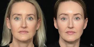 Facial Fillers Chesterfield