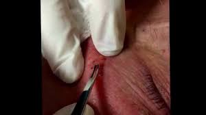 Excision of sebaceous cyst from back. Extracting Solar Comedones Favre Racouchot For Medical Education Nsfe Youtube