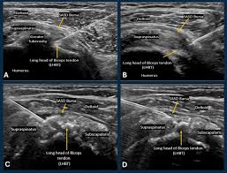 Image result for Tendon Sheath Injection