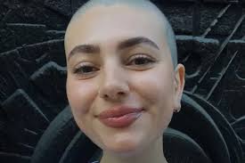 I thought the only thing I'd be good for is horror movies': East London  actress won't let burn scars define her