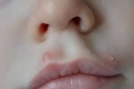 Kleine pickel auf der lippe ich habe einen pickel an der lippe, ich weis aber das das kein herpis ist, da ich schon so einigemahle herpis hatte ^^ was könnte das sein und wie bekomme ich das so schnell wie möglich wieder weg ?:dwie gesagt, es ist wahrsheinlich ein pickel^^ und Hilfe Was Kann Das Sein Eiterpickel Am Mund Forum Baby Urbia De