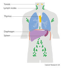 Stages Of Non Hodgkin Lymphoma Non Hodgkin Lymphoma