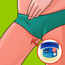 I bring to you in this video how to get rid of dark inner thighs. 10 Effective Ways To Prevent A Rash On The Inner Thighs