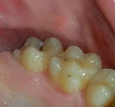 Ich Habe Bei Mir Karies Entdeckt Was Kann Ich Machen Gesundheit Zahnarzt Zahngesundheit