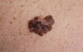 But hearing the words can still be scary. 3 Types Of Skin Cancer Diagnosis Treatment Mole Check