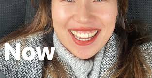 I have flaring front teeth after braces. I'm currently