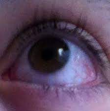 Warum Ist Mein Linkes Auge So Rot Gesundheit Augen Adern