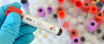 Genitalherpes Behandlung Symptome Dauer Der Infektion